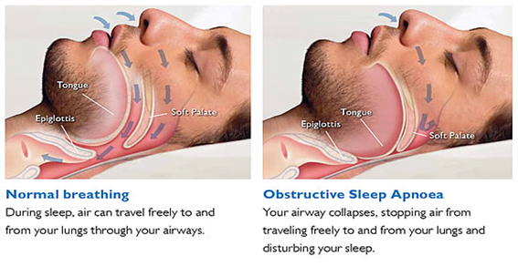 What is reddit Sleep Apnea?